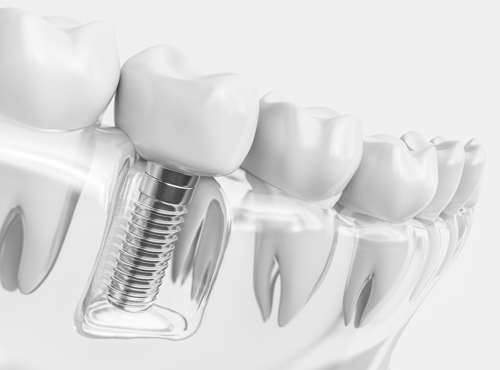 Mankato Dental Implant Specialists - What are Dental Implants?
