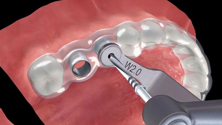 surgically guided dental implants Mankato MN