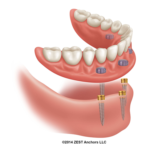 LODI Dental Implant